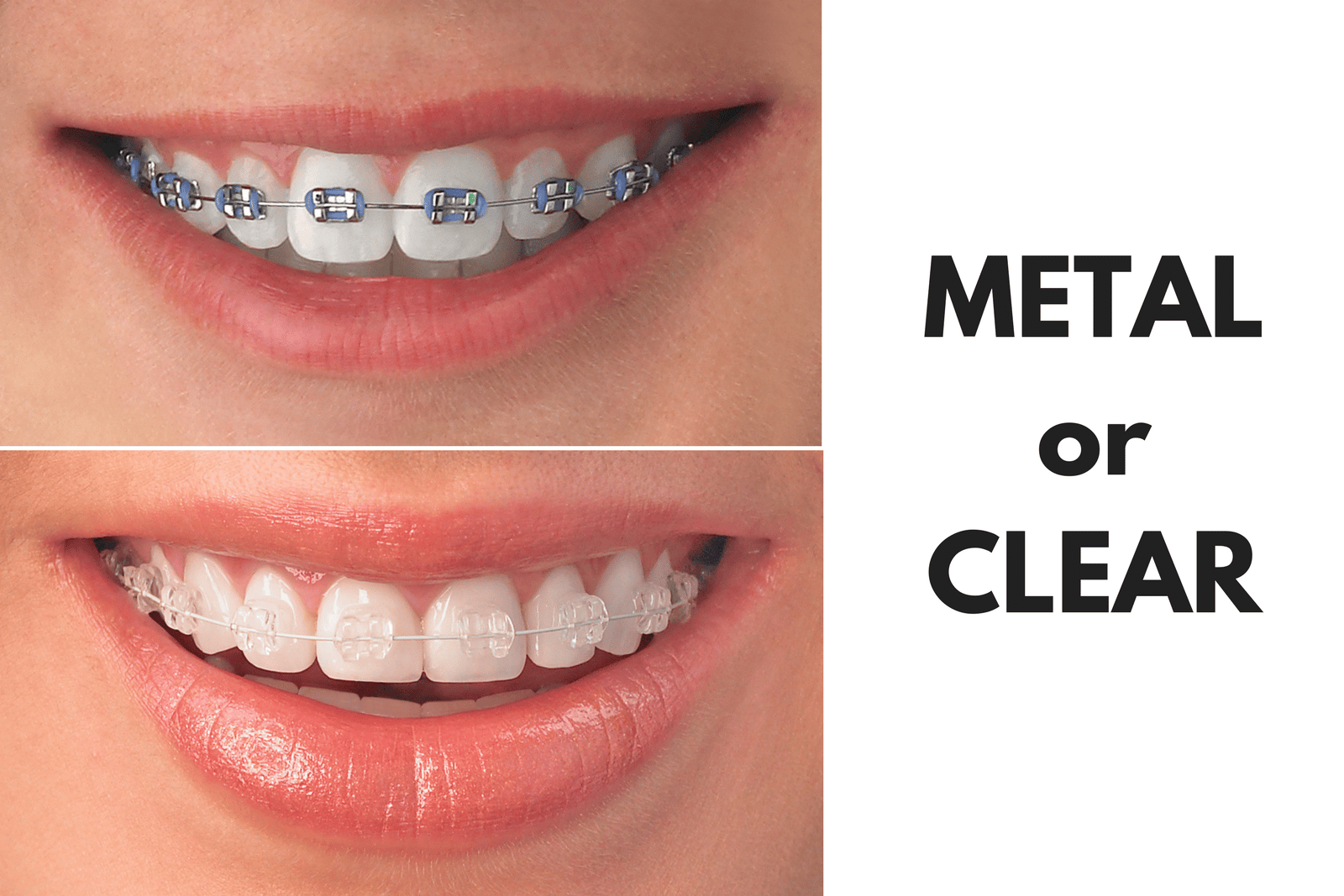 Ask Your Edinburg Dentist: Should I Get Metal or Clear Braces
