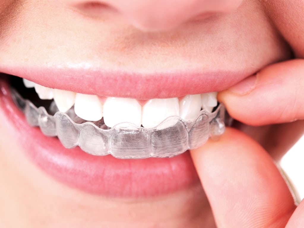 Featured image for “Ask Your Edinburg Dentist: What’s the difference between Invisalign and Metal Braces?”