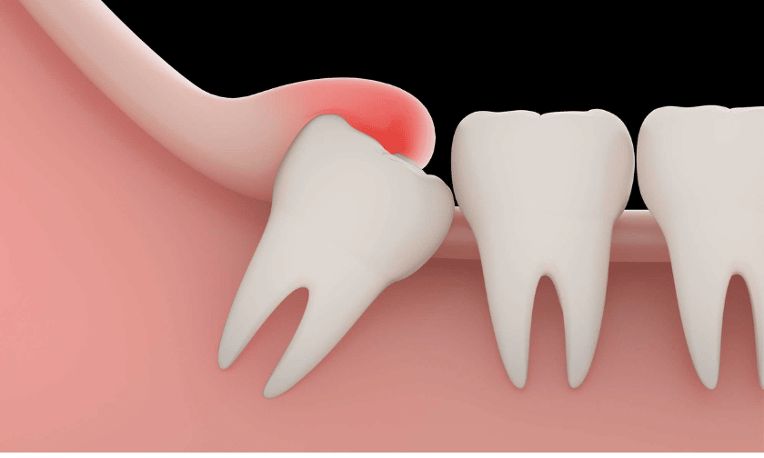 Featured image for “What You Should Know Before Getting Tooth Extraction”