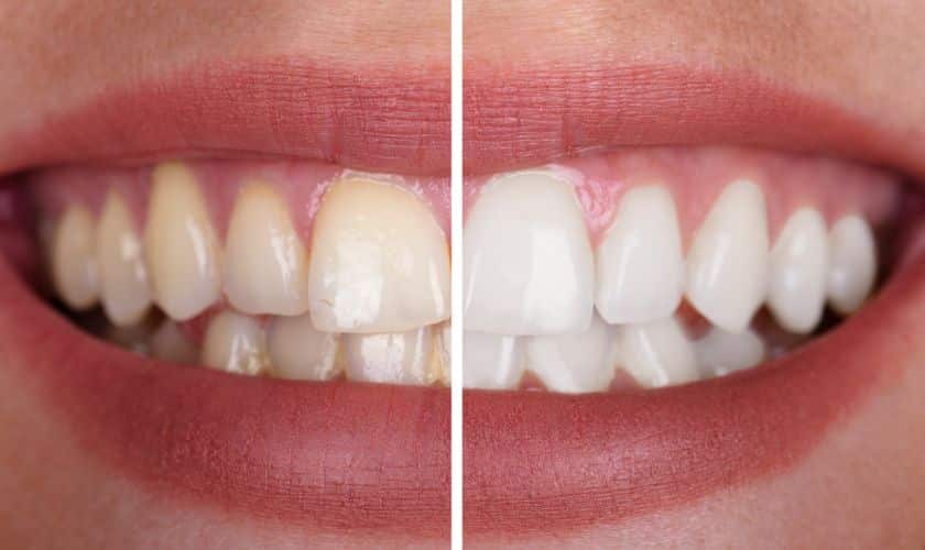 Featured image for “Teeth Whitening For Sensitive Teeth: Gentle Solutions In Edinburg”