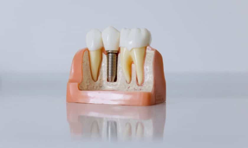 Featured image for “Dental Implants And Your Oral Health: The Connection You Should Know About”