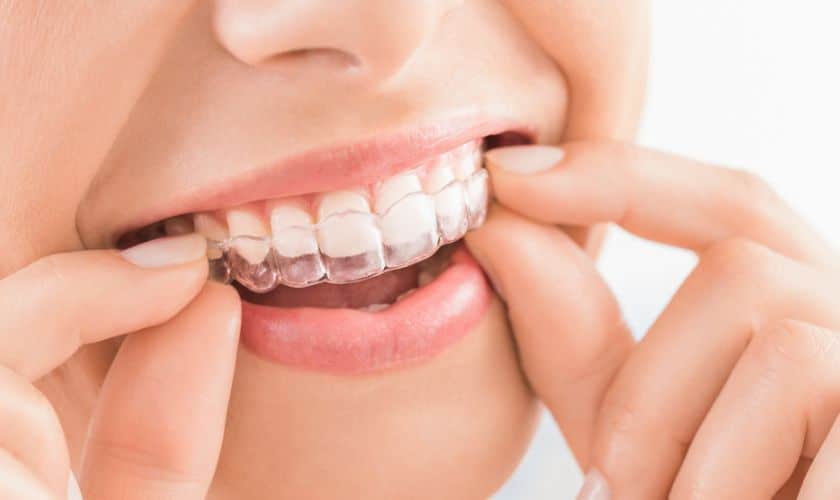 Braces or Invisalign – Comparison – What Works Better?