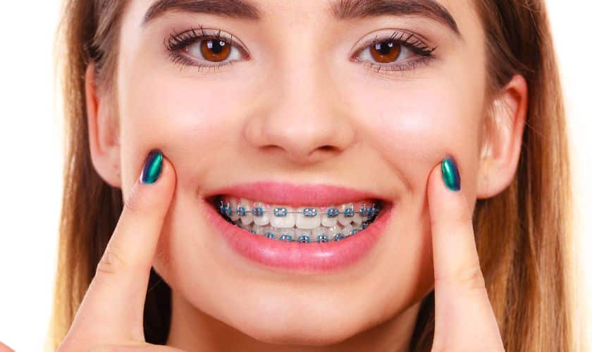 Featured image for “How long do braces last?”