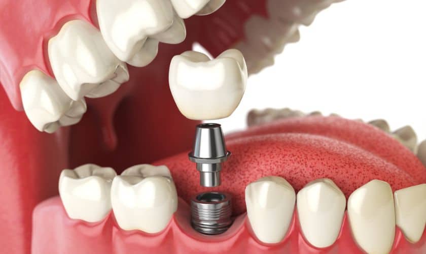 dental implants Edinburg