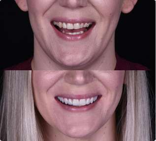 Before and after comparison of smile transformation showing improved teeth whitening and alignment results.