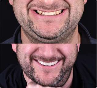 Before and after smile transformation showing improved teeth whitening and dental work results.