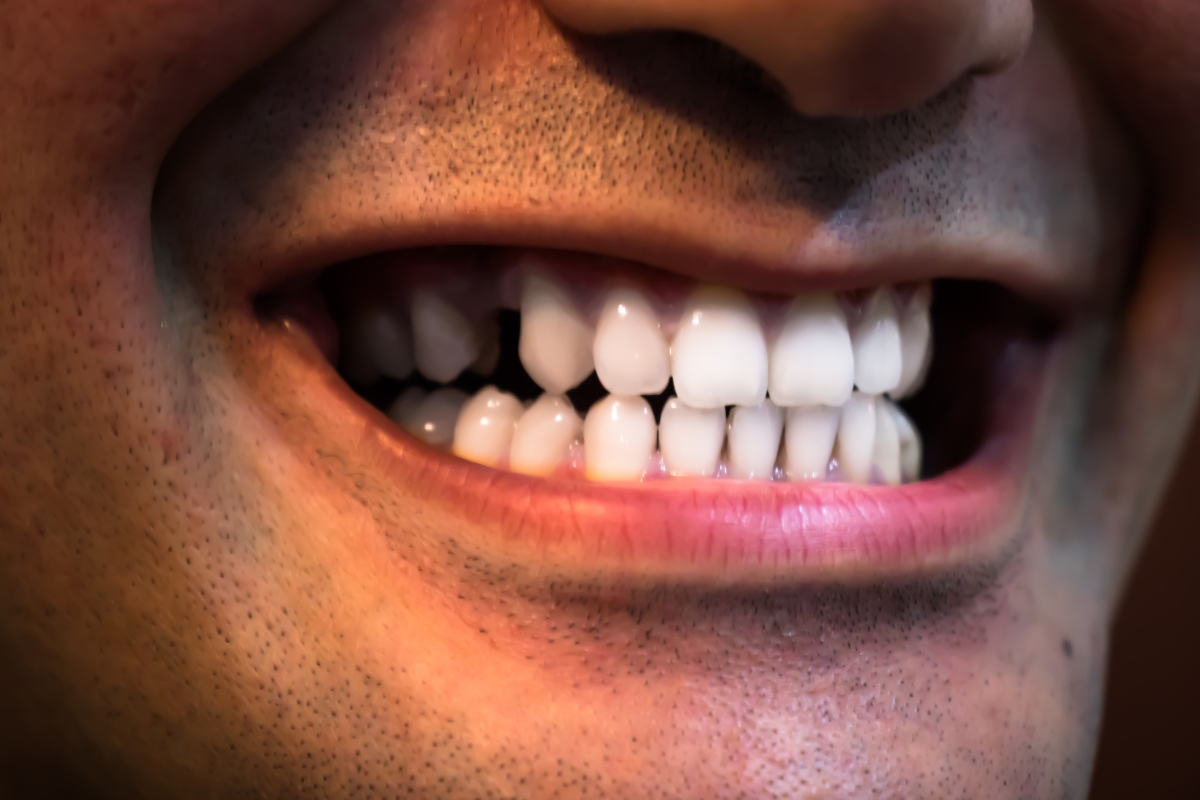 Featured image for “How Long Does Professional Whitening Last? Dentist-Backed Answers”