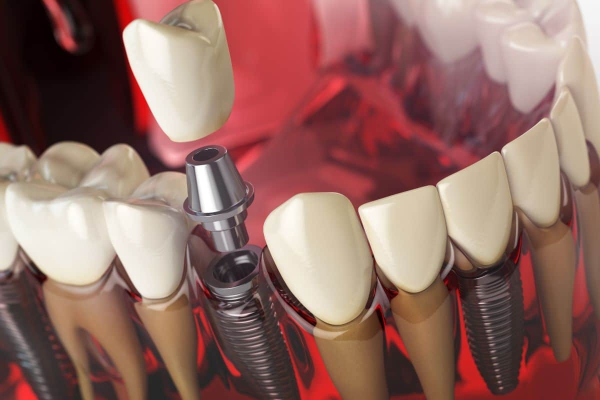 3D dental implant illustration showing crown placement on implant fixture among natural teeth.