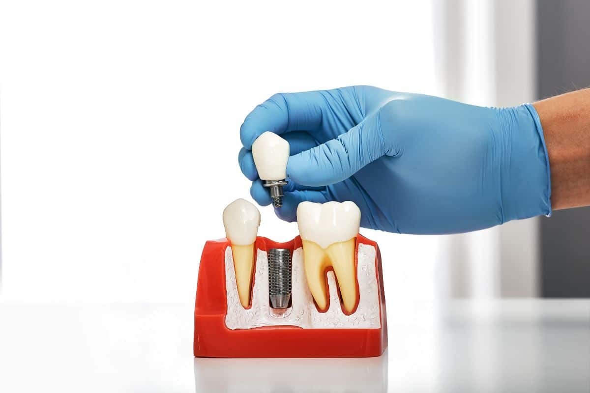 Dentist holding dental implant crown above model showing implant placement between natural teeth.