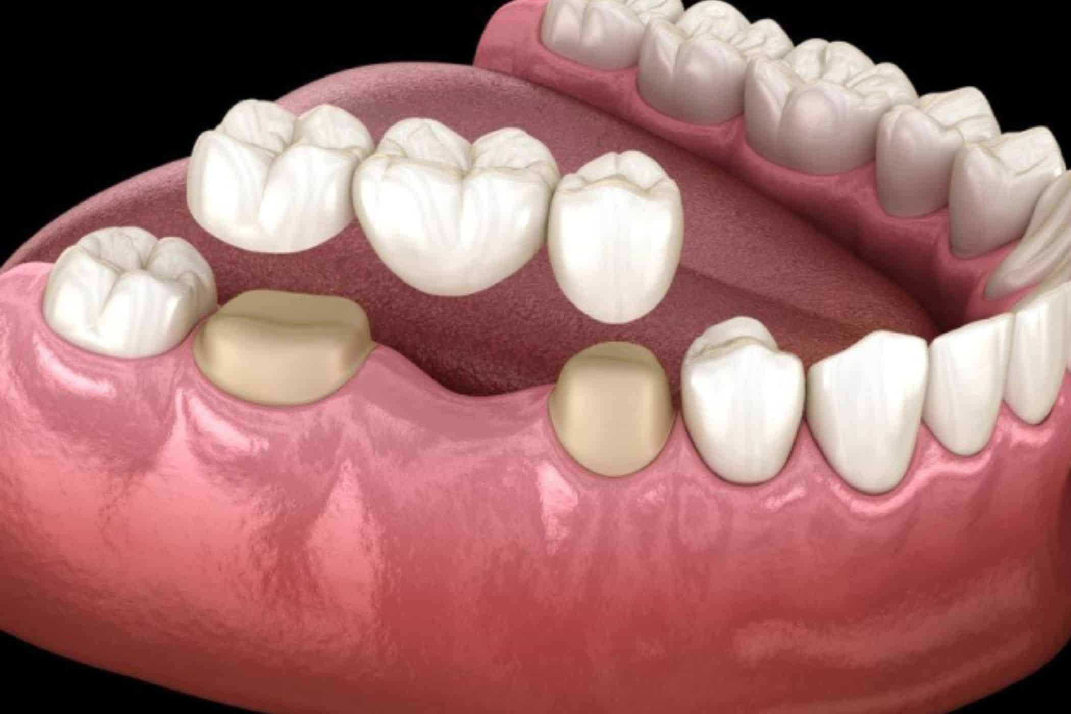 Featured image for “10 Signs You May Need a Dental Bridge”